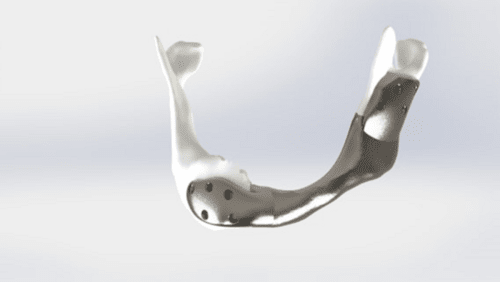 Netherlands Cancer Institute carried out first successful operation with custom 3D-printed titanium lower jaw Image credit: Mobius 3D Technology (M3DT)